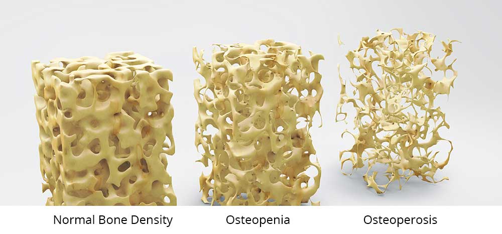 bone density