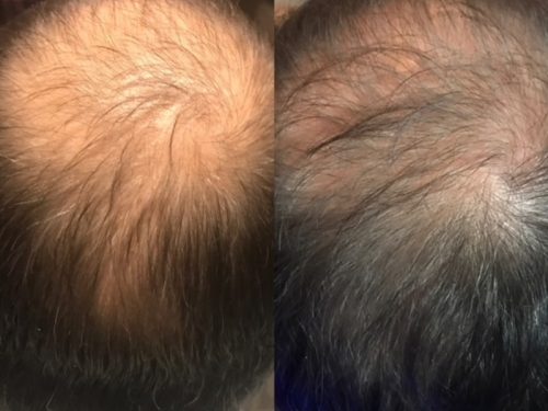 Hair restoration therapy before and after photos of scalp in Idaho Falls at Rosemark, formally a Bella Dea salon skin procedure