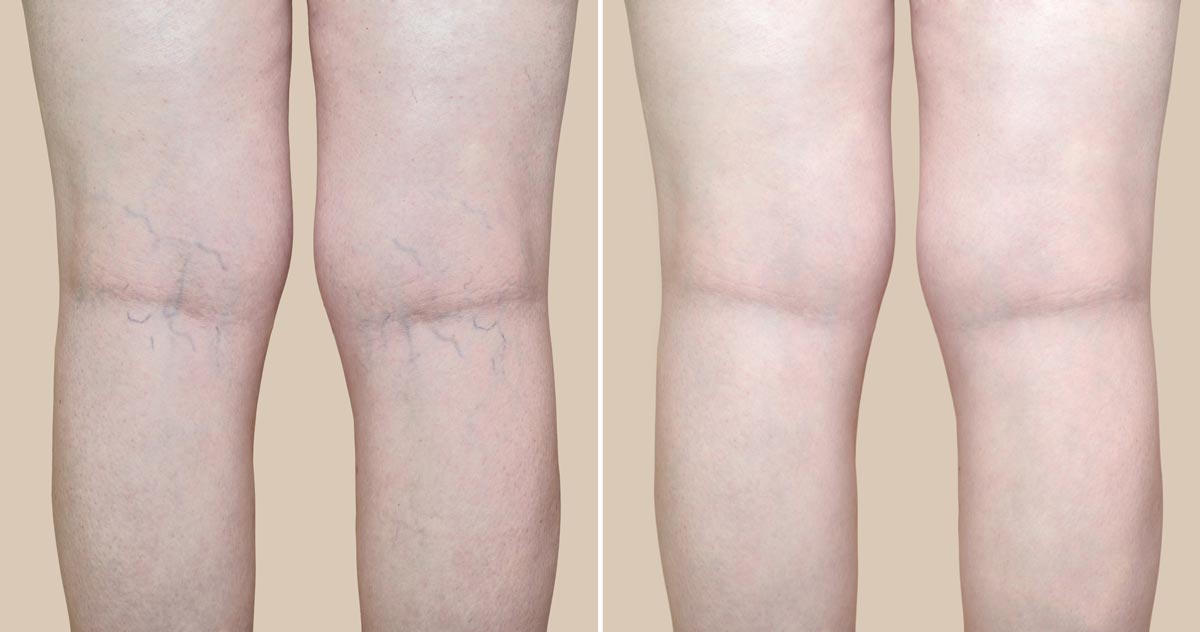 Laser Spider Vein Treatment in Spokane & Coeur d'Alene