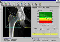 bone-density-scan-Idaho-Falls.