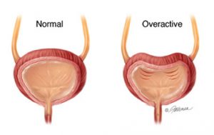 normal vs overactive bladder