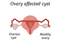 Ovarian Cysts - Symptoms, Diagnosis and Treatment