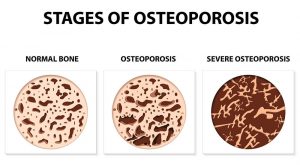 rosemark bone density idaho falls womens care