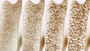 rosemark bone density osteoporosis idaho falls womens care