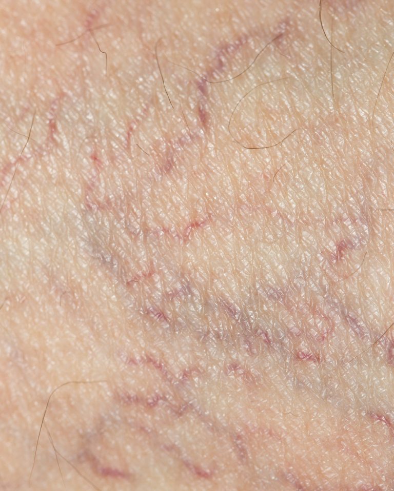 close-up of treatable spiderveins.