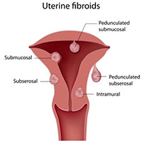 Overview of uterine fibroids.